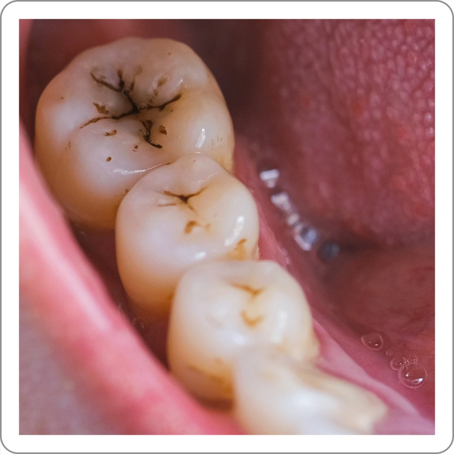 Mài răng quá sâu khi bọc sứ có thể gây viêm tủy